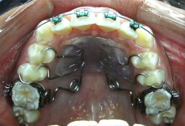 Fig. 8 Intraoral superior