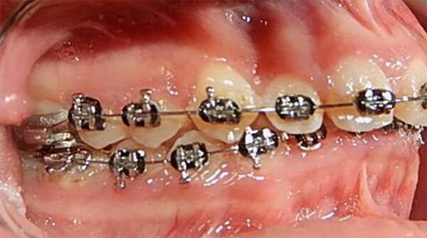 Fig. 9 Intraoral derecha