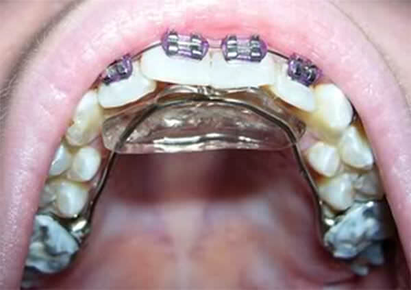 Fig. 12 Foto intraoral oclusal superior con bite plate