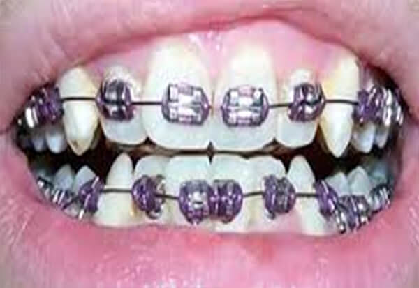 Fig 13 Intraoral de frente