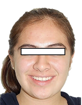 Fig.14 Extraoral de frente