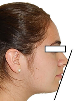 Fig. 15 Extraoral de Perfil