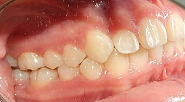Fig. 17 Derecha