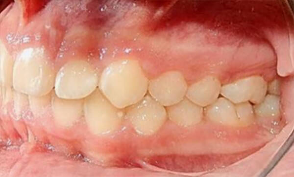 Fig. 18 Intraoral izquierda