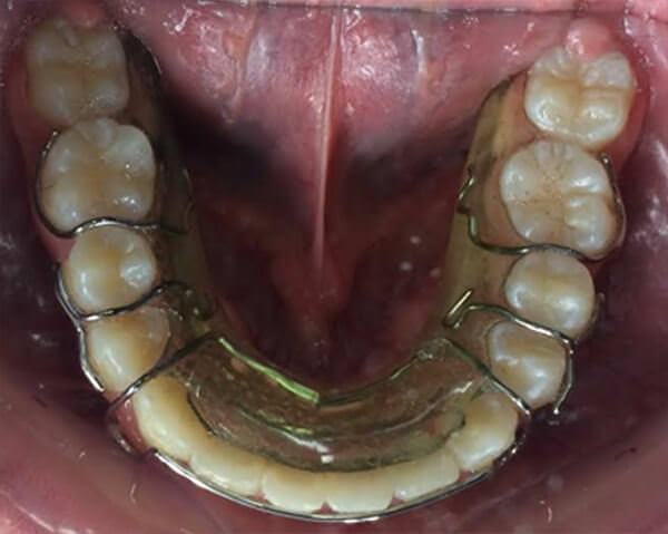 Fig. 21 Hawley modificado inferior