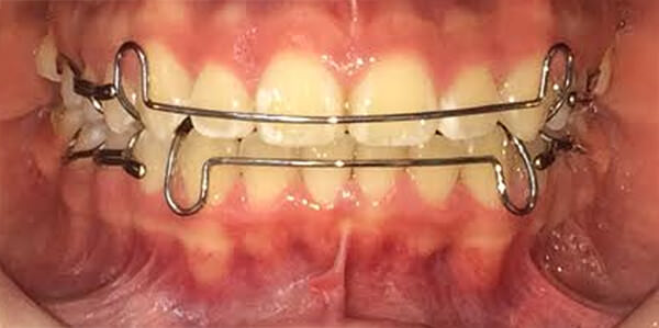 Fig. 23 Retenedores circunferenciales