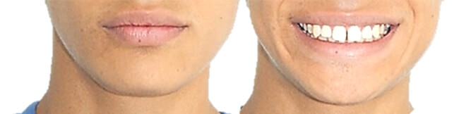 Fig. 1 Frente y sonrisa