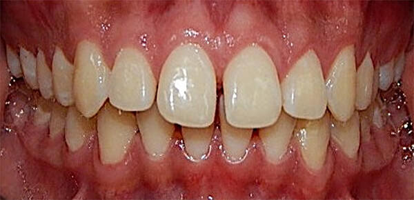 Fig. 3 Intraoral de frente