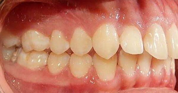 Fig. 4 Clase II molar bilateral