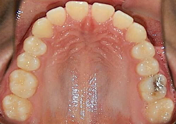 Fig. 6 Fotografia Oclusal superior de inicio