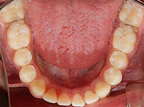 Fig. 7 Oclusal inferior de inicio