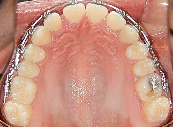 Fig.16 Vista oclusal superior de progreso