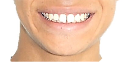 Fig. 20 Sonrisa inicio