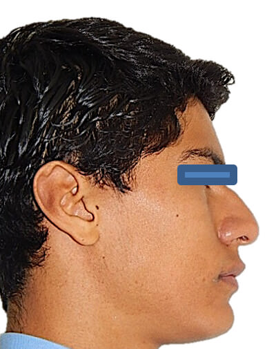 Fig. 22 Perfil inicio final