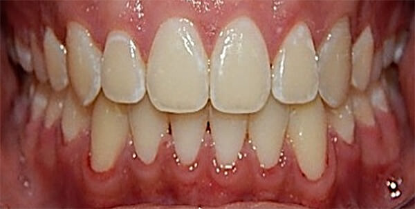 Fig. 23 Intraoral de frente