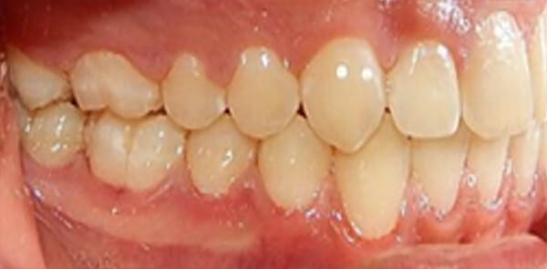 Fig 24 Lateral derecha final