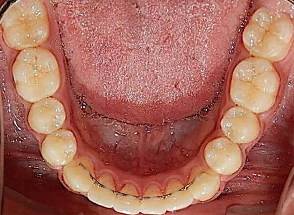 Fig. 26 Oclusal inferior de final con retenedor fijo de 3-3