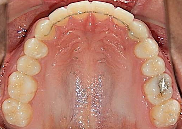 Fig. 27 Oclusal superior de final, retenedor fijo de 3-3