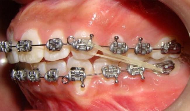 Fotografía bilateral arco de acero 0,018 con helix , curva reversa acentuada con cadena elastomérica desde helix hasta hook de molar del lado derecho 3oz de presión. Elásticos clase II bilateral 2oz. de presión. Nótese caso de extracción asimétrica.