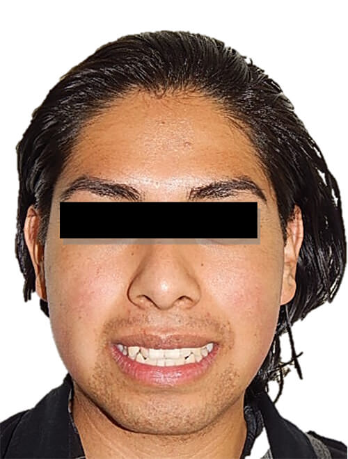 Fig. 1. Extra oral de frente sonrisa