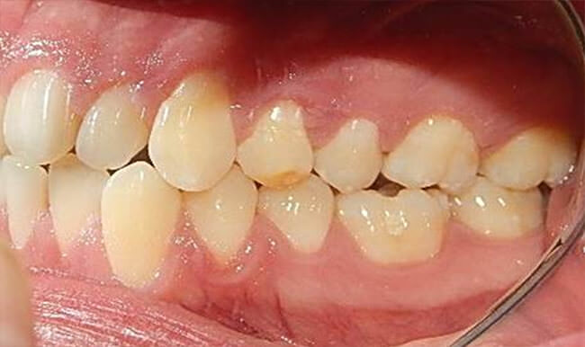 Fig. 5 Intra oral izquierda