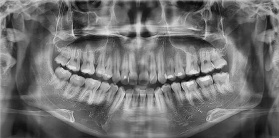 Fig. 7 Rx. Panorámica se observa 28 dientes presentes.