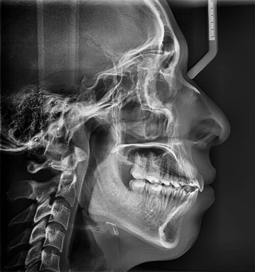 Fig. 9 Radiografía lateral de cráneo progreso