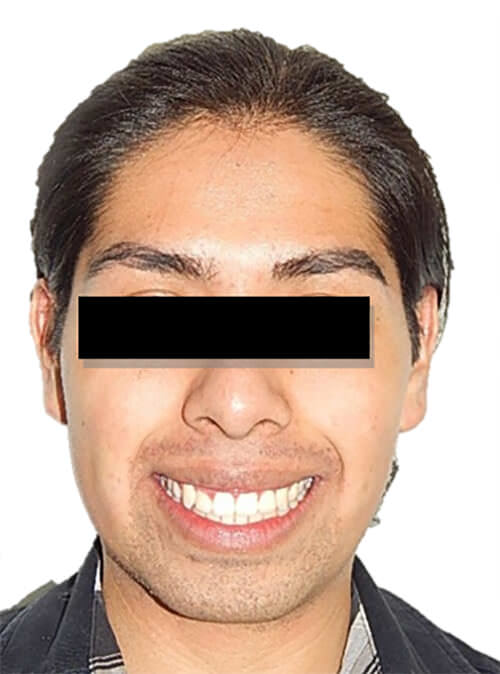 Fig. 10 Frente sonrisa final