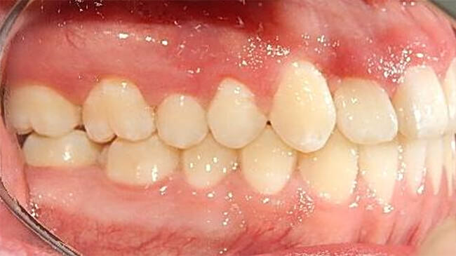 Fig. 13 Intraoral derecha final