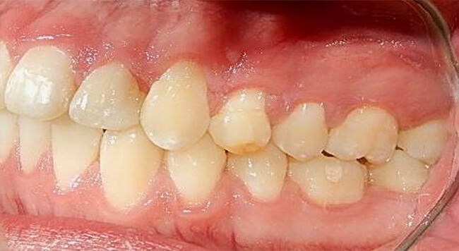 Fig. 14 Intraoral izquierda