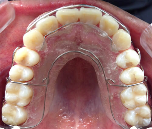Fig. 15 Oclusal superior final