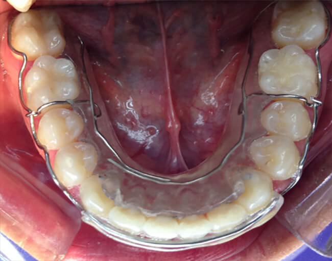 Fig. 17 Circunferencial inferior
