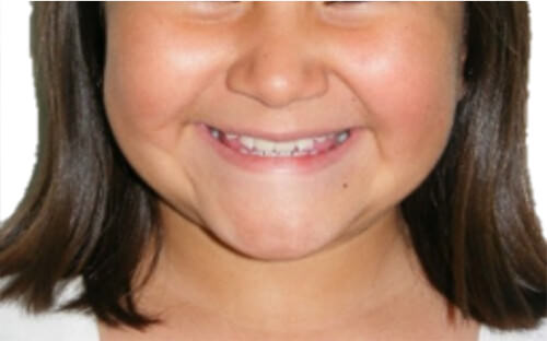 Fig. 3 Sonrisa