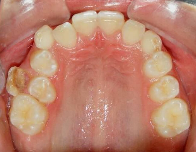 Fig.7 Intraoral oclusal