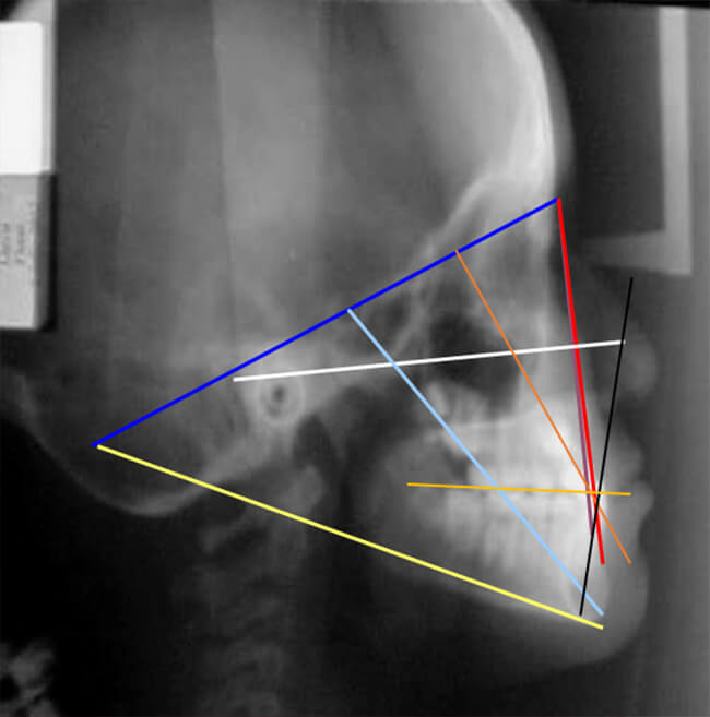 Fig.9 Radiografía lateral de cráneo de inicio