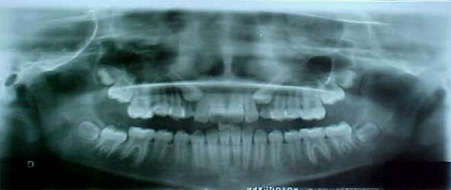 Fig.10 Radiografía panorámica de inicio.