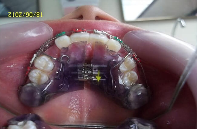 Fig.11 Oclusal de progreso