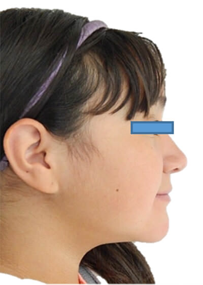Fig 16 Perfil