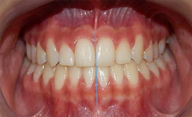 Fig. 17 Intraoral frente final.