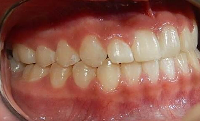 Fig. 18 Intraoral lateral derecha final