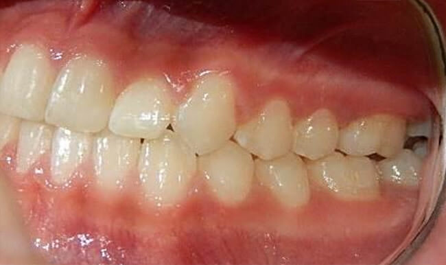 Fig. 19 Intraoral lateral izquierda final