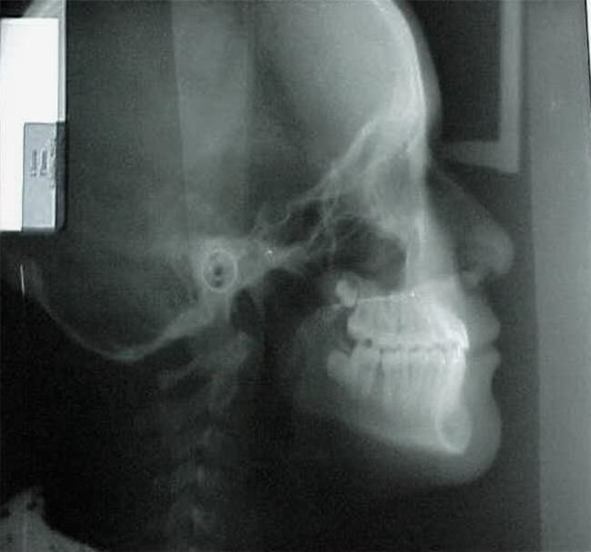 Fig.20 Lateral de cráneo final