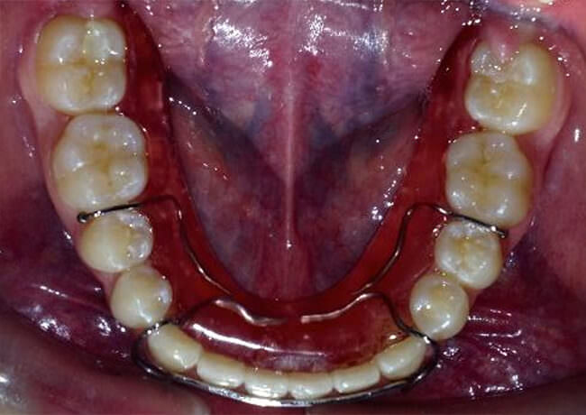 Fig.22 Retenedor Hawley inferior