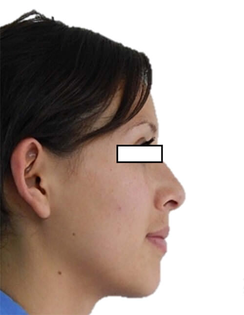 Fig 2.- Perfil