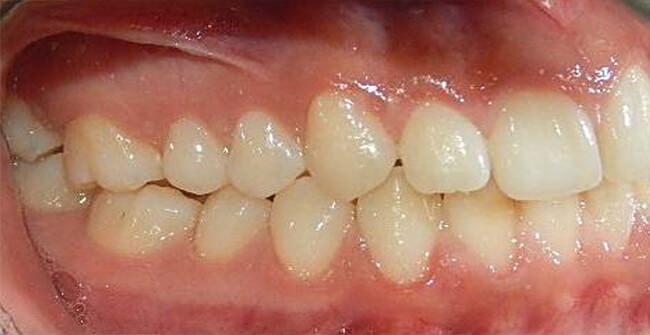 Fig 4.- Lateral derecha