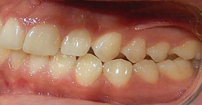 Fig 4.- Lateral derecha