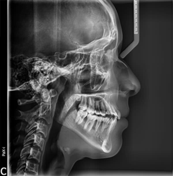Fig. 6.- Radiografía lateral de cráneo