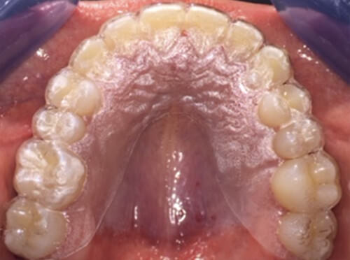 figura 20, oclusal superior