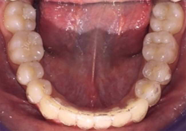 Figura 21.- Oclusal Inferior