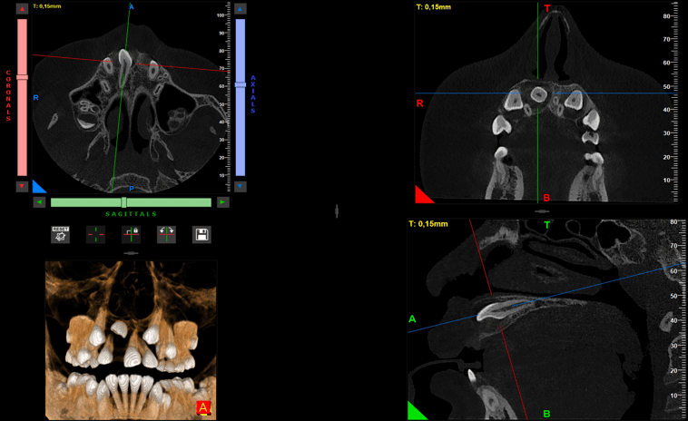 Fig 5. Cortes en ventana MPR y renderizado 3D